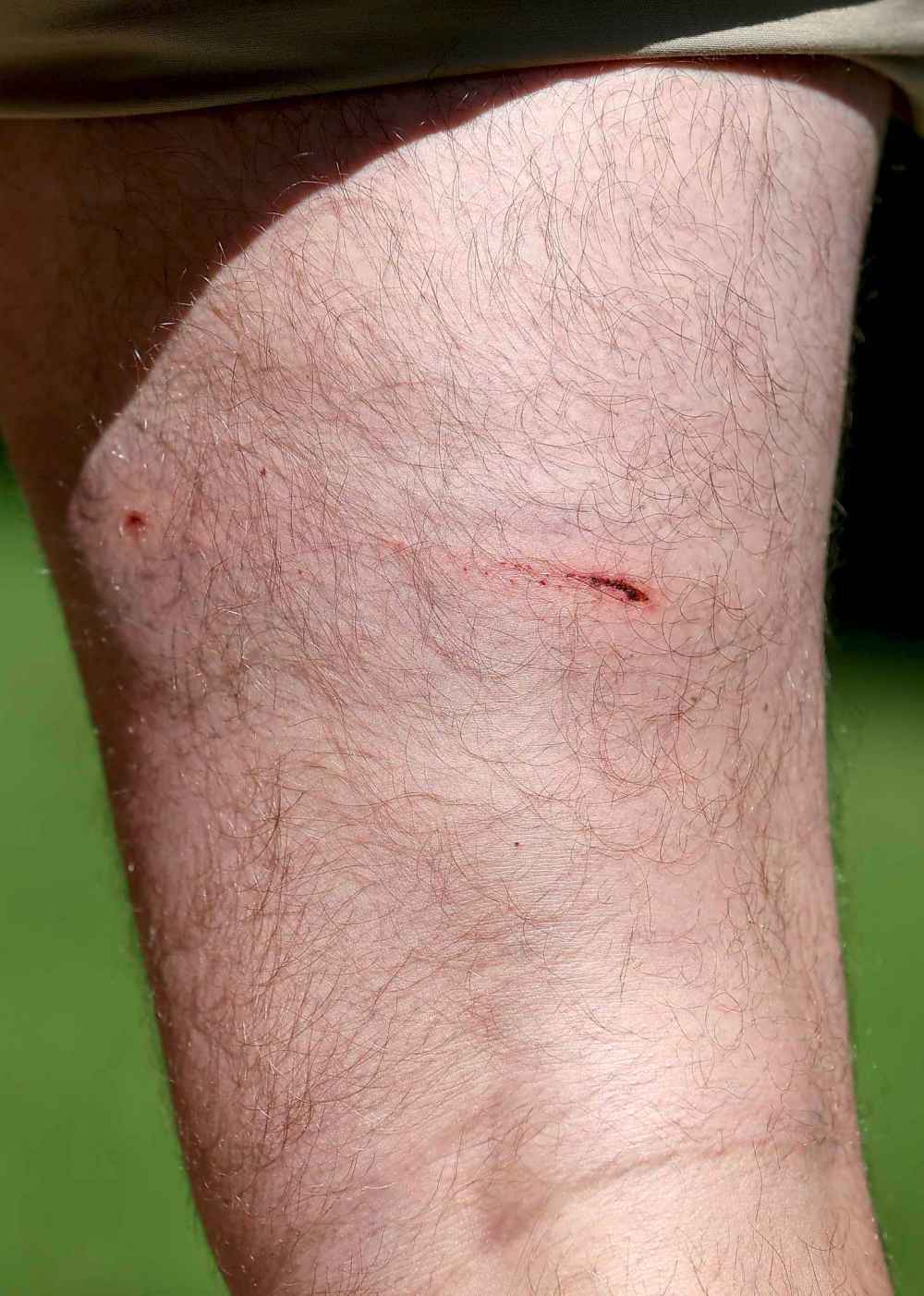 Ryan Potter's leg after being attacked by a black bear while hiking on the Mantario Trail Monday. (Trevor Hagan / Winnipeg Free Press)