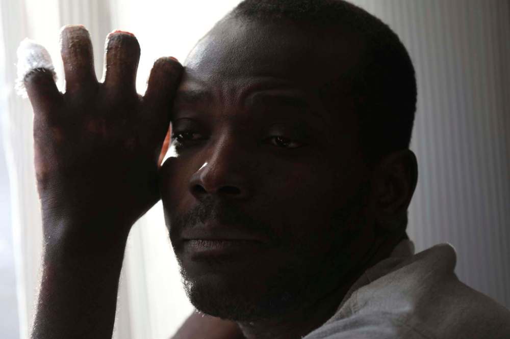 Kangni Kouevi lost part of three fingers on one hand. (Ruth Bonneville / Winnipeg Free Press)