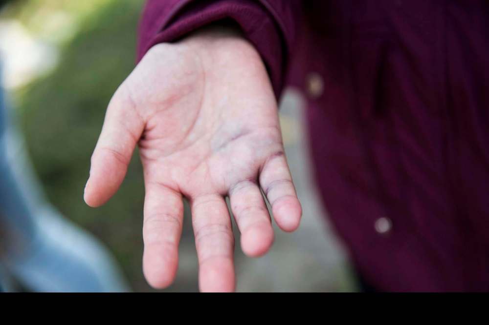 Melissa Harper's hand was bruised after the ordeal. ((Mikaela MacKenzie / Winnipeg Free Press)