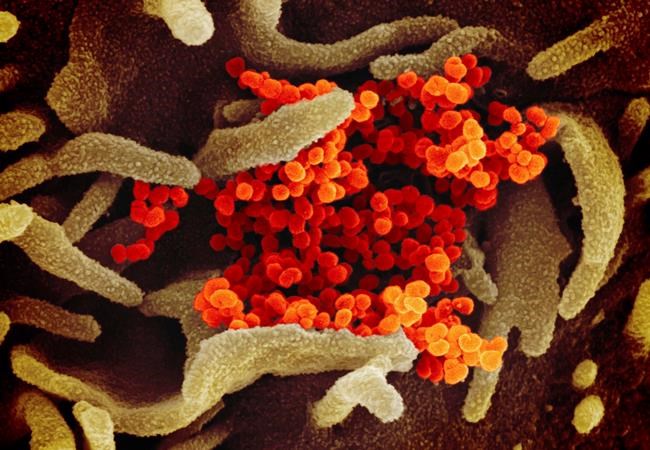 This undated electron microscope image made available by the U.S. National Institutes of Health in February 2020 shows the Novel Coronavirus SARS-CoV-2, orange, emerging from the surface of cells, green, cultured in the lab. Also known as 2019-nCoV, the virus causes COVID-19. The sample was isolated from a patient in the U.S. (NIAID-RML via AP)