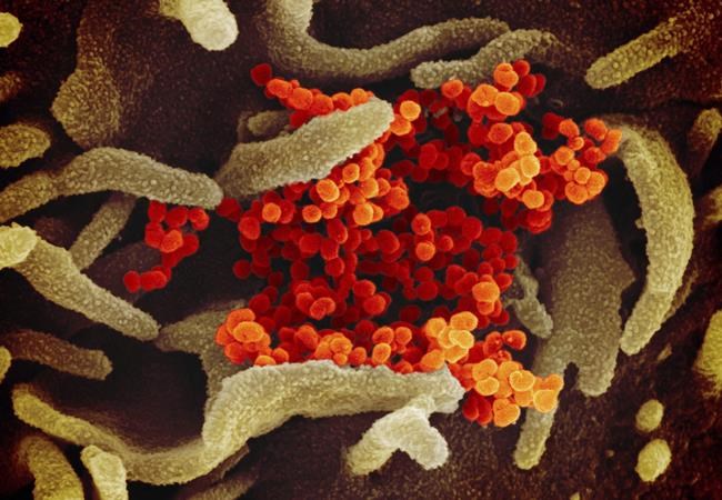 This undated electron microscope image made available by the U.S. National Institutes of Health in February 2020 shows the Novel Coronavirus SARS-CoV-2, orange, emerging from the surface of cells, green, cultured in the lab. THE CANADIAN PRESS/HO - NIAID-RML via AP