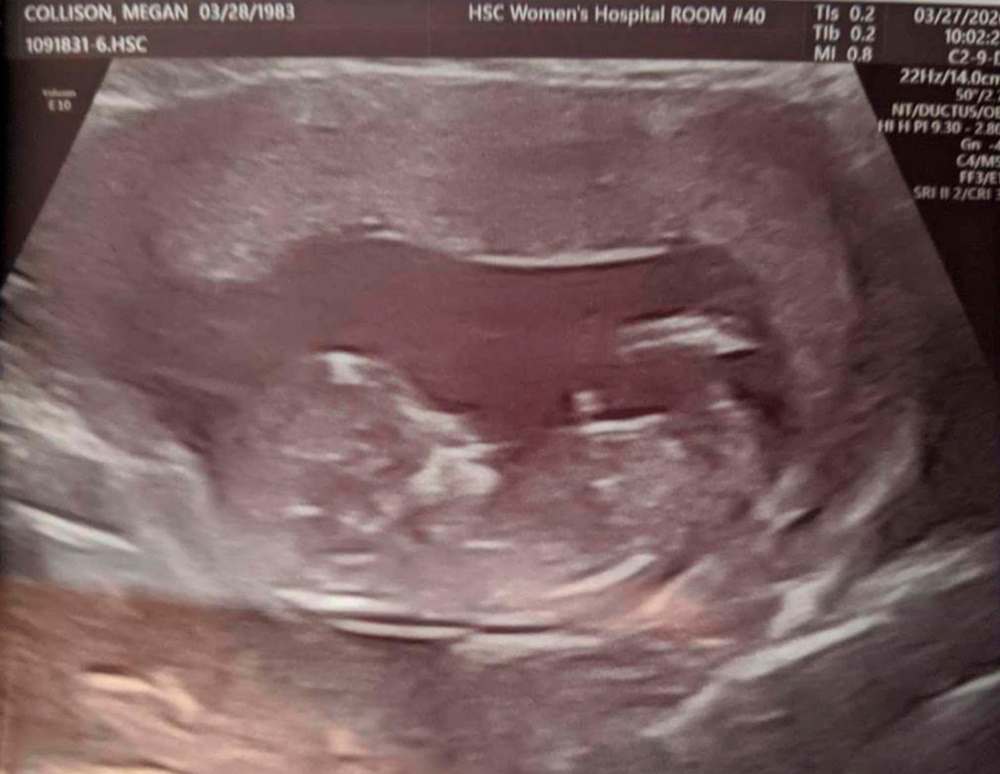 Megan Collison’s ultrasound