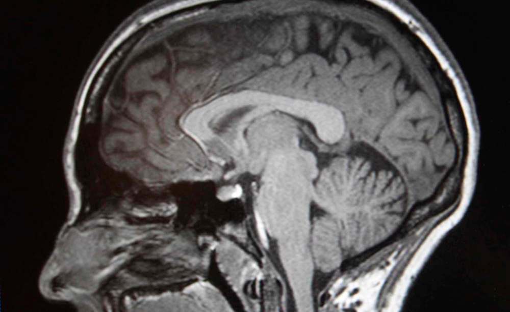 The young doctor’s departure comes on the heels of a 40 per cent turnover of academic neurologists in Winnipeg in the last three years. These doctors look after patients with epilepsy, stroke, multiple sclerosis and neuromuscular diseases. (Joe Bryksa / Winnipeg Free Press files)