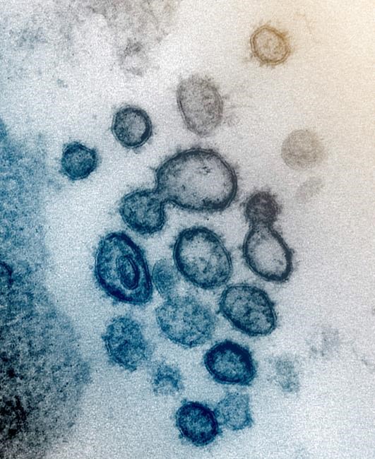 This undated electron microscope image made available by the U.S. National Institutes of Health in February 2020 shows the Novel Coronavirus SARS-CoV-2. Also known as 2019-nCoV, the virus causes COVID-19. The sample was isolated from a patient in the U.S. Dozens of research groups around the world are racing to create a vaccine as COVID-19 cases continue to grow. (NIAID-RML via AP)