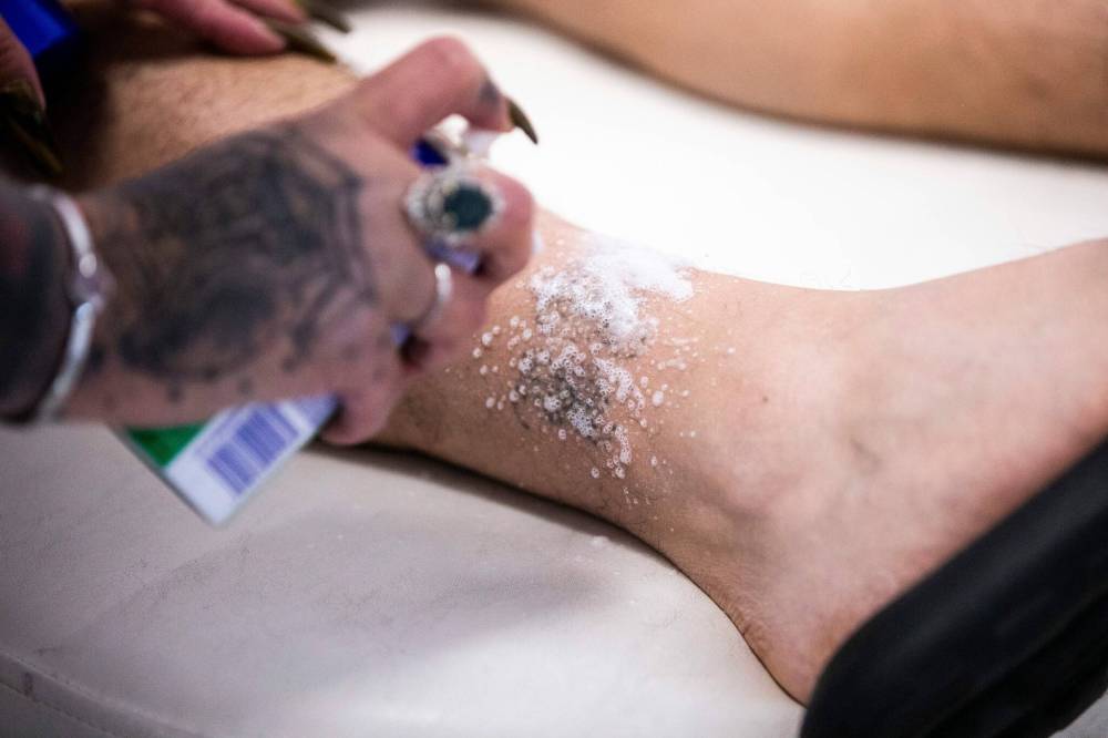 The man getting his tattoo removed from his ankle wore long socks to cover it. (Mikaela MacKenzie / Winnipeg Free Press)